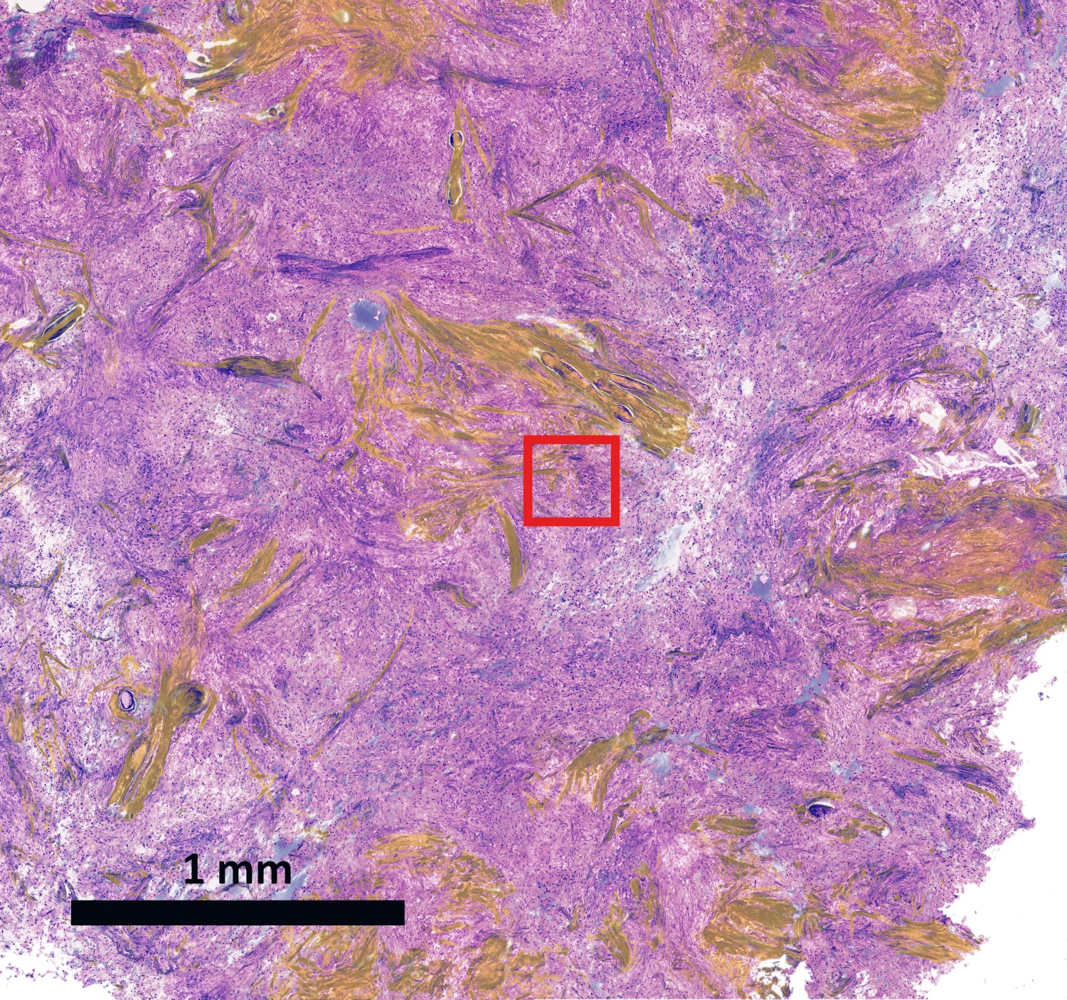 Stimulated Raman histology overview of brain tissue, roughly 1 millimeter field of view